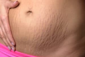 strech marks in pregnancy